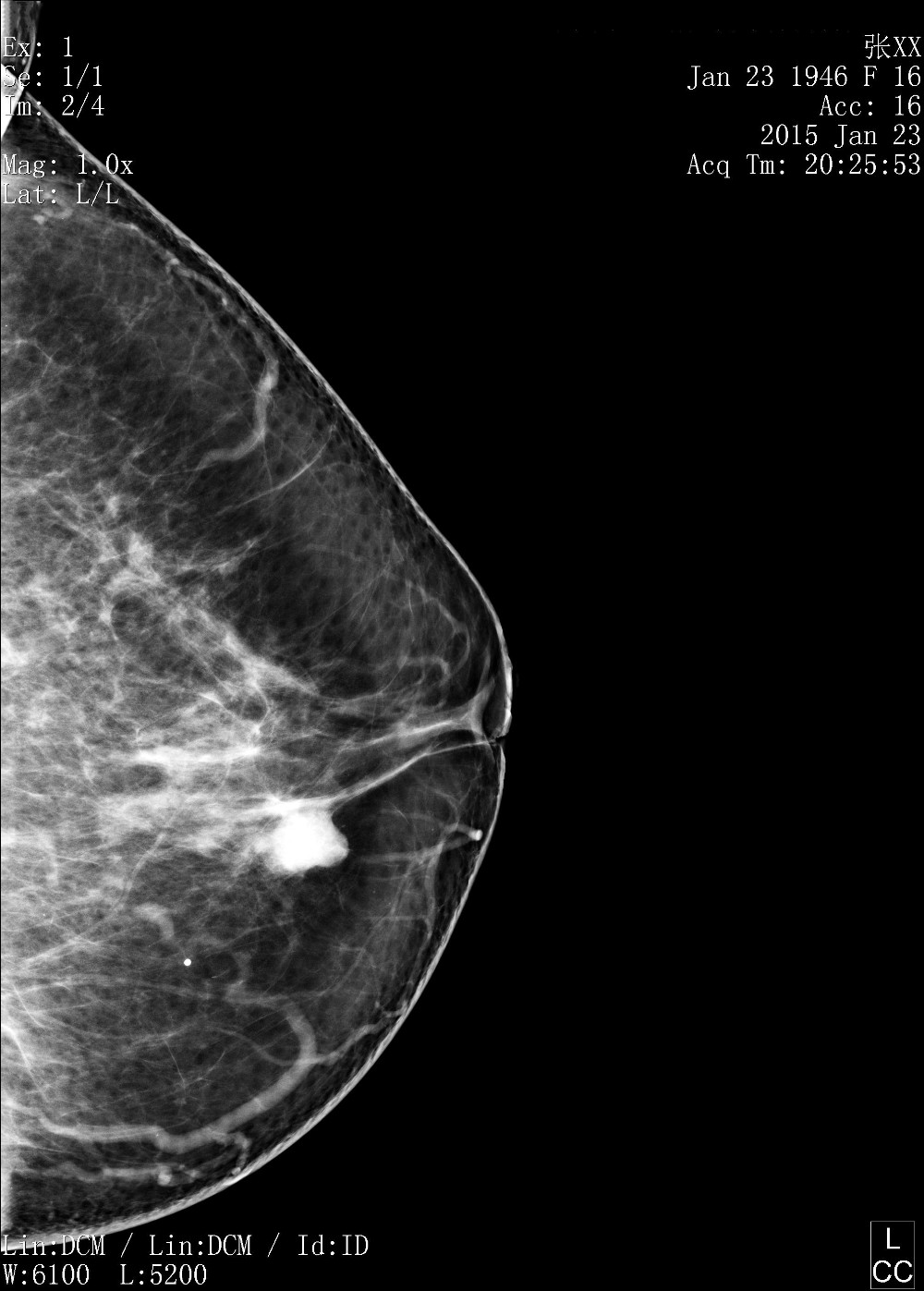 Full Digital Mammography System with Panel Detector for Sales