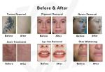 Picosecond Laser Machine For Skin Whitening Tattoo Removal Freckle Pigment