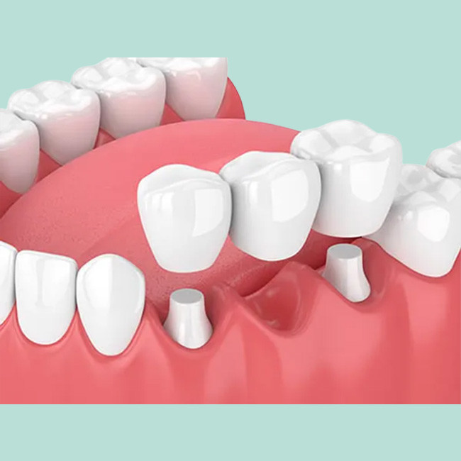High Strength Dental Crown Bridge Realistic Appearance Good Stability Bite Force