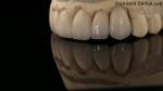 Full Contour Zirconia Crown and High Aesthetic Natural Dental Bridge 5 Year