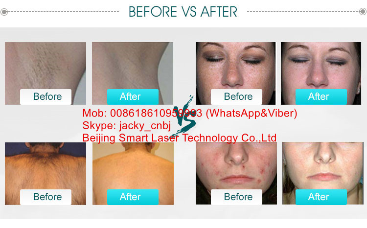 Portable SHR IPL Hair Removal Machine , Small Elight IPL Beauty Device