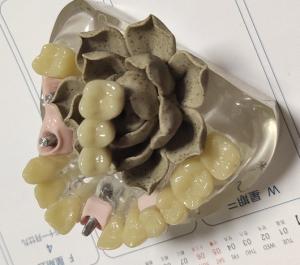 Quality 100 Percent Biocompatibility PMMA Provisional Crown wholesale