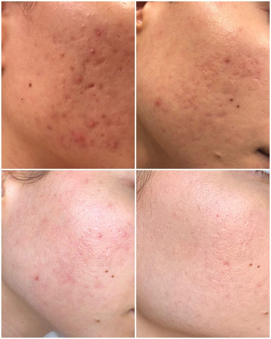 40w 60W Fractional CO2 Laser Machine For Wrinkle Removal Stretch Mark Scar Removal Tightening