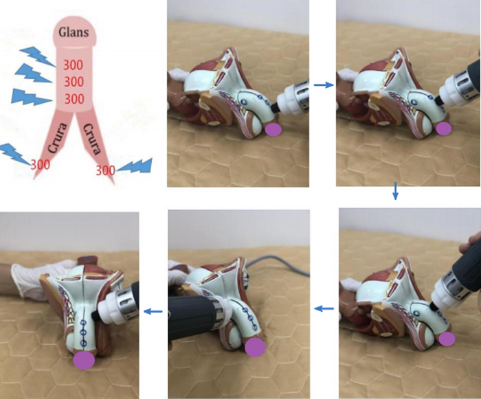 Noninvasive Mini Shockwave Therapy Devices For ED Therapy Machine 350W shockwave therapy for back pain