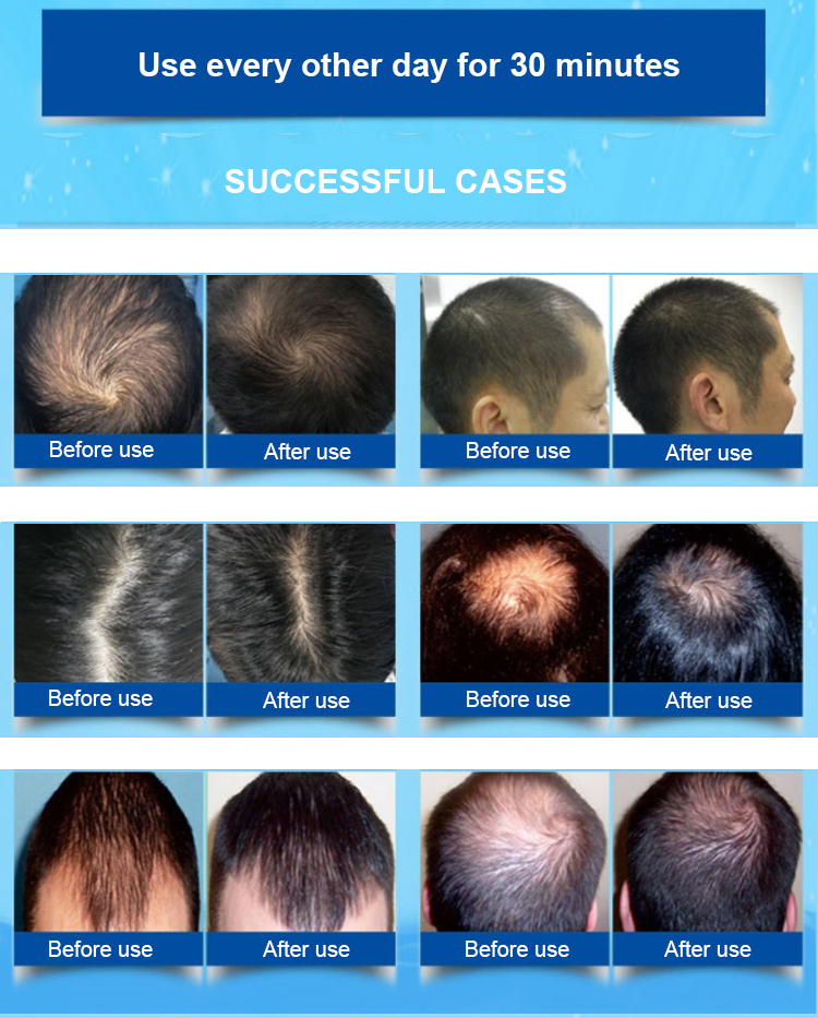 650nm 5mW Home Laser Hair Growth Caps Laser Hat To Grow Hair