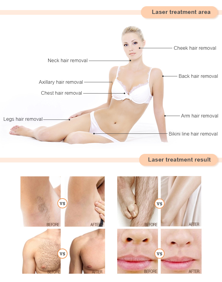 Laser Hair Removal Equipment with Cooling System of Water Wind Semi-Conductor TEC Cooling
