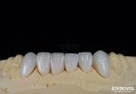 Glossy Surface Texture Feldspathic Veneer Natural Looking Porcelain Veneer