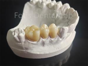 Quality Wear Resistance Zirconia Layered With Porcelain Dental Material wholesale