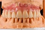 Comfortable Wear Acrylic Denture Finished With Tooth Arrangement Technology