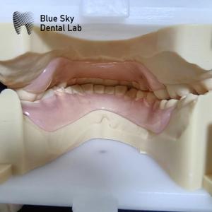 Resin Valplast Flexible Partial Dentures Before And After Valplast Partial Denture