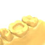 Precision Light Cure Resin Radiopaque Dental Resin For 3d Printing