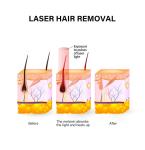 Commercial Home Portable Permanent Laser Hair Removal Machine 808nm With