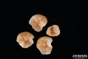 Quality Customizable Shape Composite Inlays And Onlays Dental Stain Resistance Long Lasting wholesale