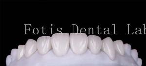 Quality Polishing Finishing Cosmetic Teeth Veneer Covers For Beautiful Smile wholesale