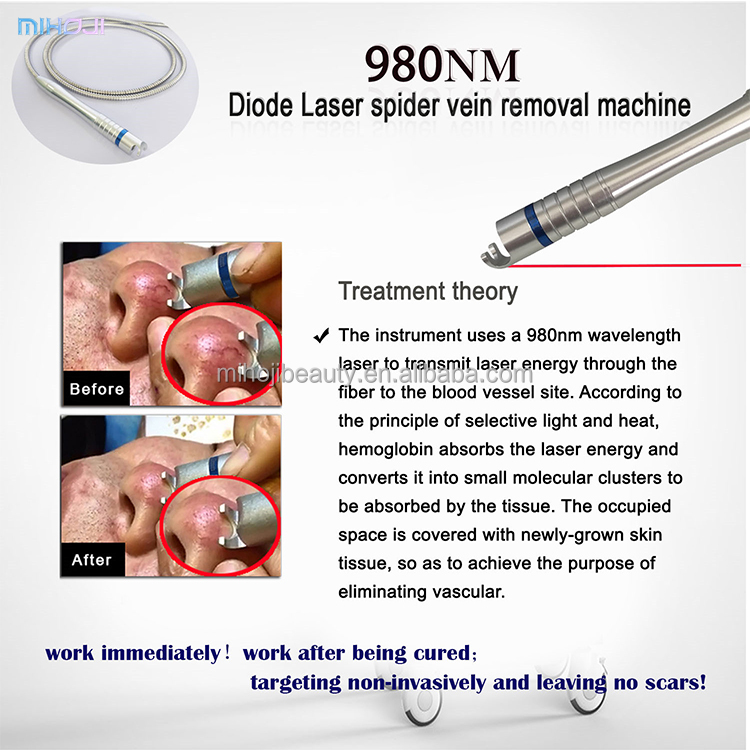 980nm Laser Liposuction Machine Portable Diode Laser for Vascular Removal