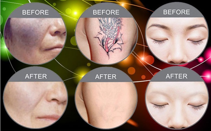 Multifunctional IPL Beauty Machine Hair Removal Acne Treatment Machine