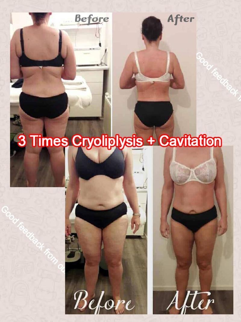 Cryo+Laser+40k Cavitation for Body Face 360 Surrounding Cooling Technology Slimming Machine for Beauty Clinic Salon