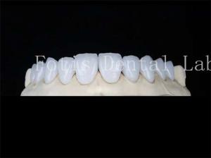 Quality Customized Natural Porcelain Veneers Dental Lab Veneers Stain Resistant wholesale