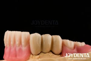Quality Stainless Steel Prostheses Partial Dentures Attachments Polished Surface Ball Attachments wholesale
